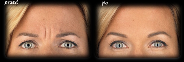 botoks_przed_po
