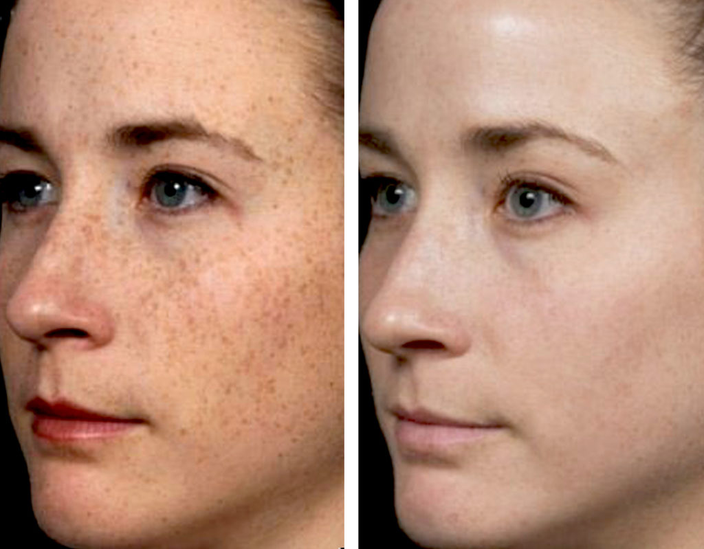 cosmelan-before-after-photo